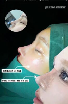 nâng mũi