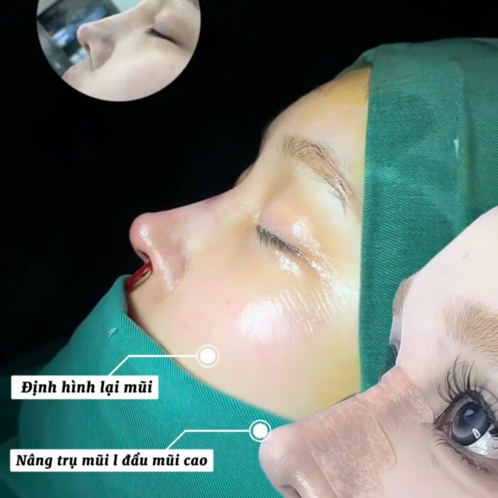nâng mũi