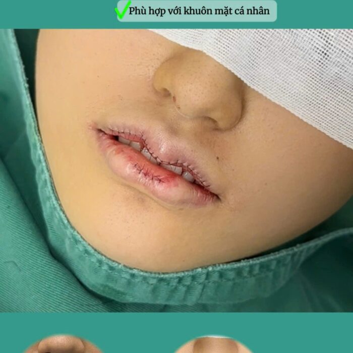 tạo hình môi